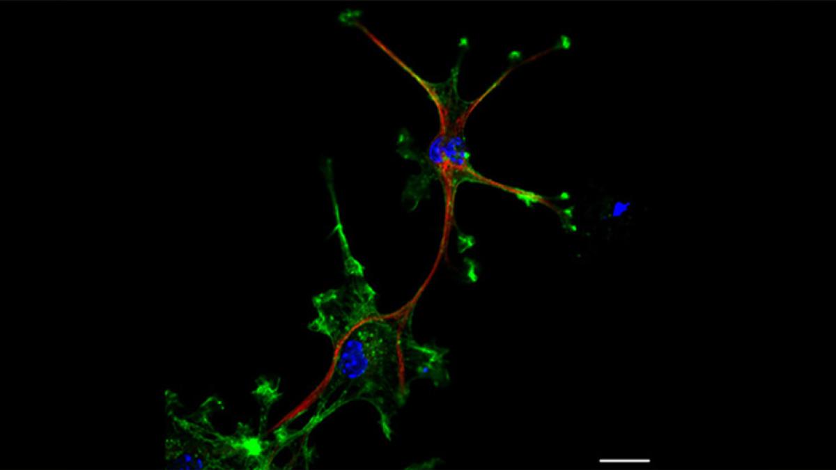 Green GBM cells and one green and red cell mimicking an astrocyte