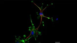 Green GBM cells and one green and red cell mimicking an astrocyte