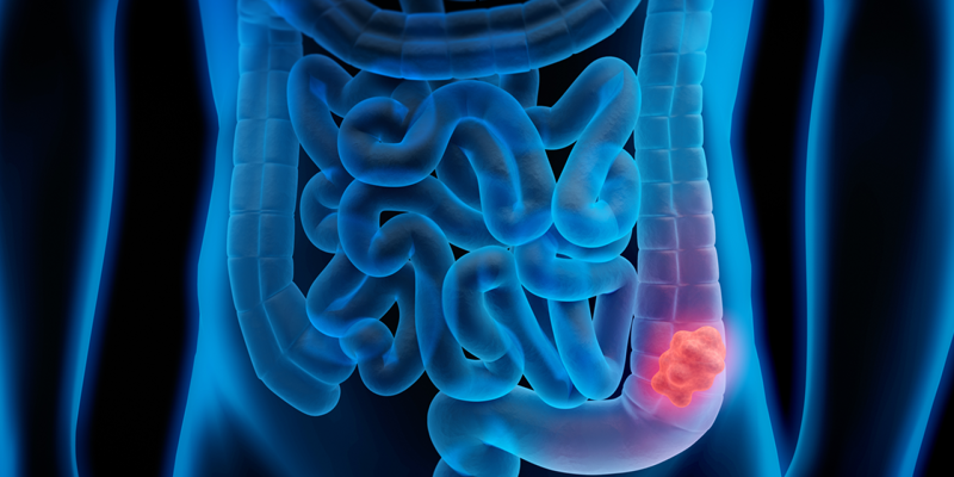 Medical illustration of Colorectal Cancer - Polyp