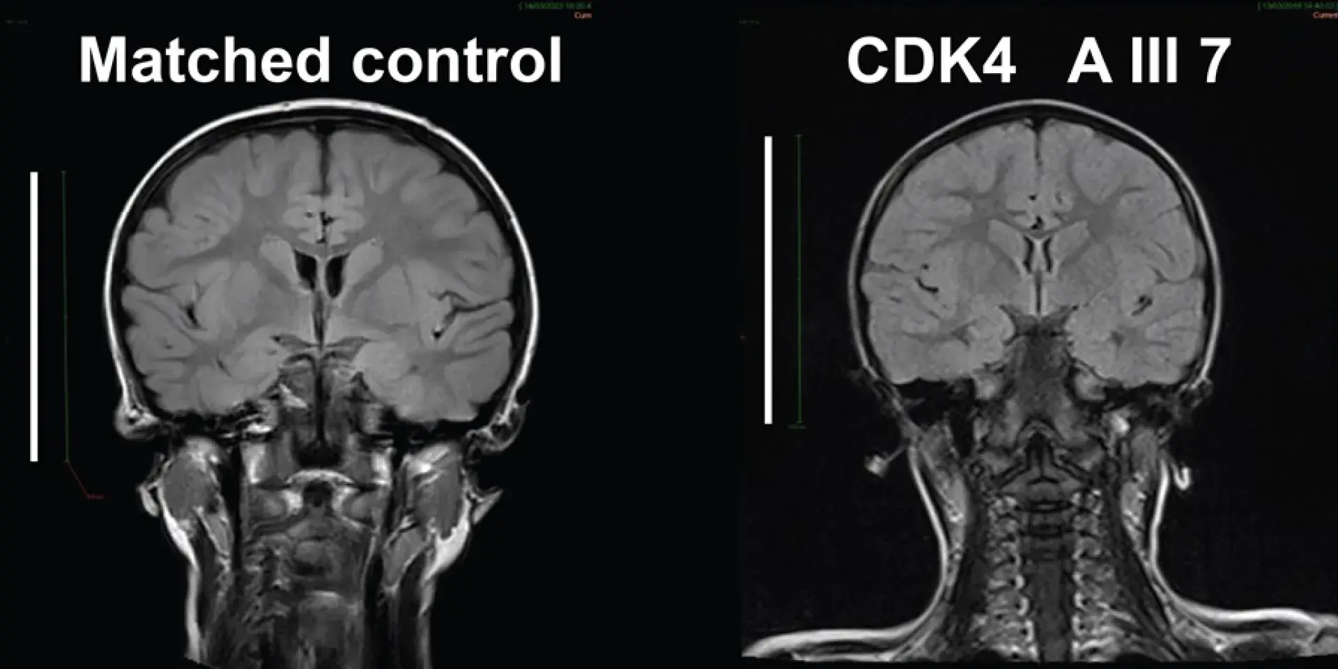 MRI scan of two brains (one control, one microcephaly)