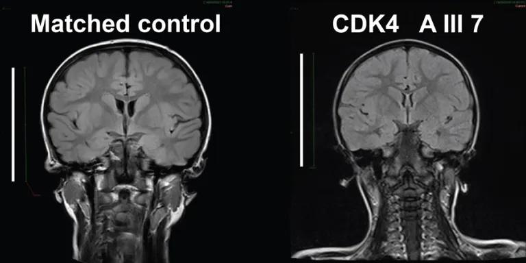 MRI scan of two brains (one control, one microcephaly)