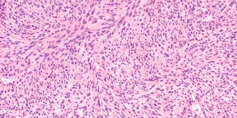 Microscopic image of a leiomyosarcoma, a type of soft tissue sarcoma of smooth muscle