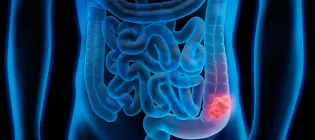 Medical illustration of Colorectal Cancer - Polyp