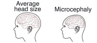 Drawing of average head size and microcephaly head size