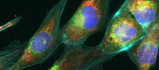 A confocal image of some cancer cells 