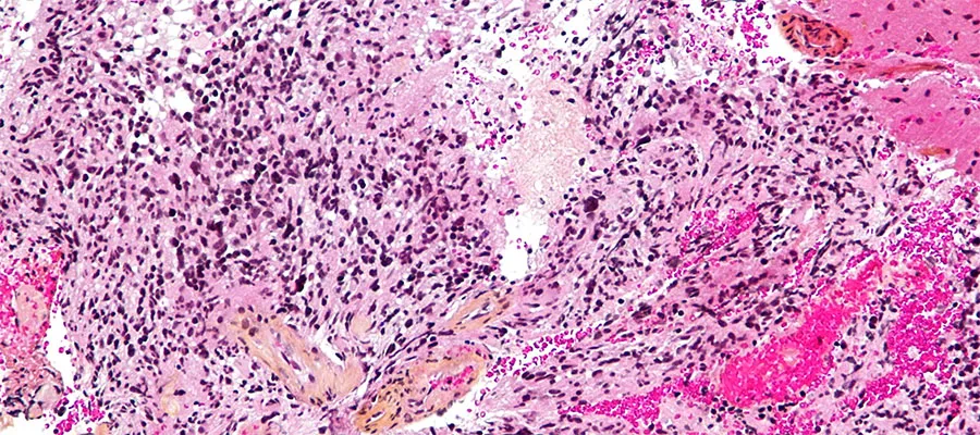 Histopathological section of a brain tumour.