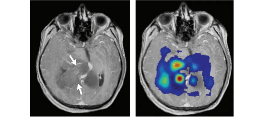 MRI images of glioblastoma (from Kao et al. BioMed Res Int: 970586).
