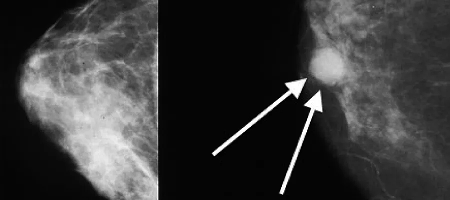 Kindlin-1-regulates-mammary-tumour-metastasis