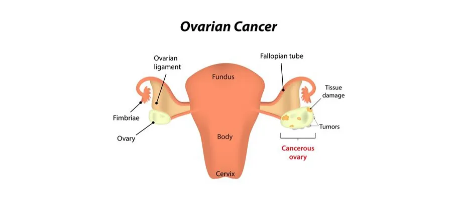 Ovarian cancer diagram
