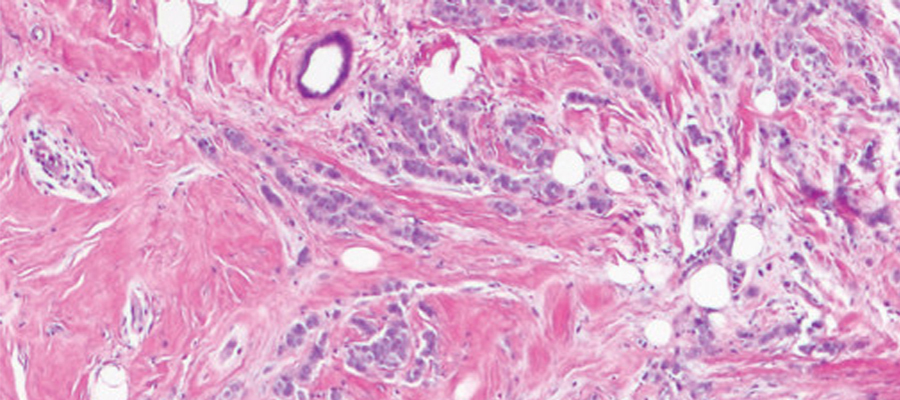 Histopathologic image of invasive breast cancer