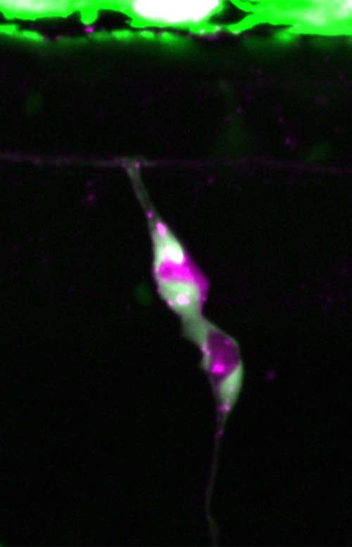 Melanocyte stem cells in development and human disease