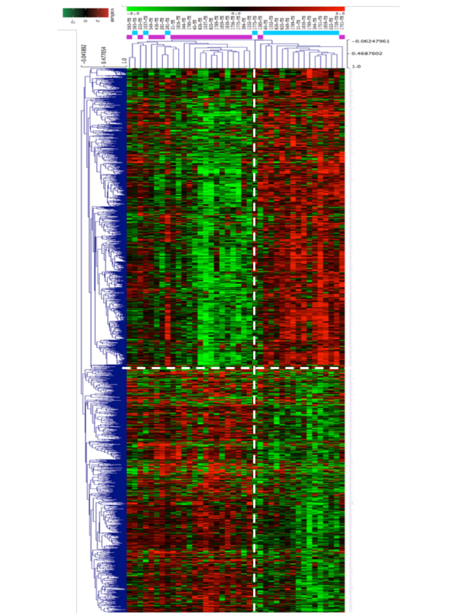 Two-class paired differential gene expression analysis tumour epithelial/stromal ILC samples dissected by Laser-capture